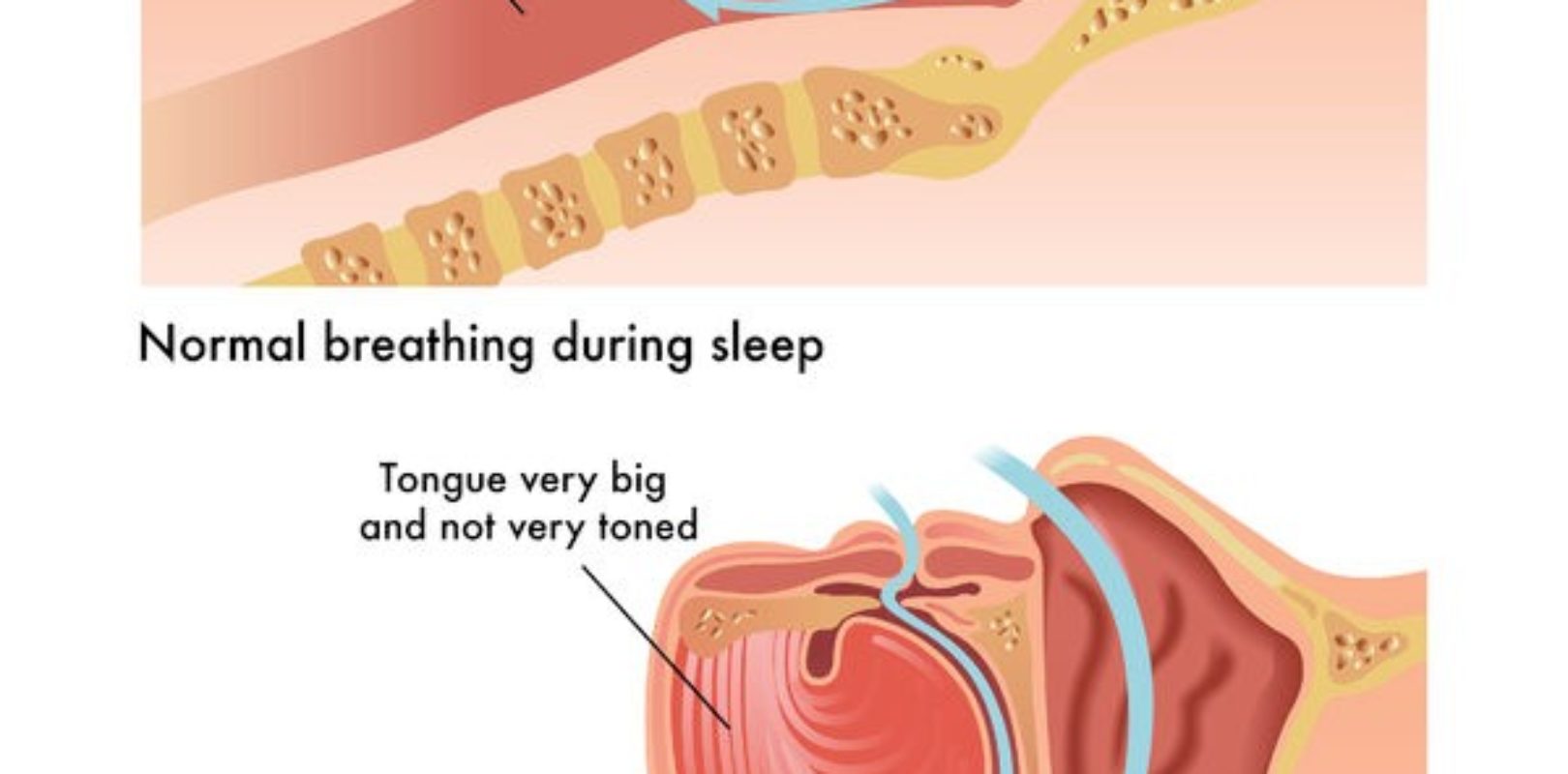 Obstructive Sleep Apnea Osa Symptoms Treatments And Causes Help U Sleep 5204