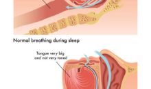 Obstructive sleep apnea (OSA): Symptoms, Treatments and Causes