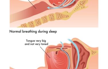 Obstructive sleep apnea (OSA): Symptoms, Treatments and Causes